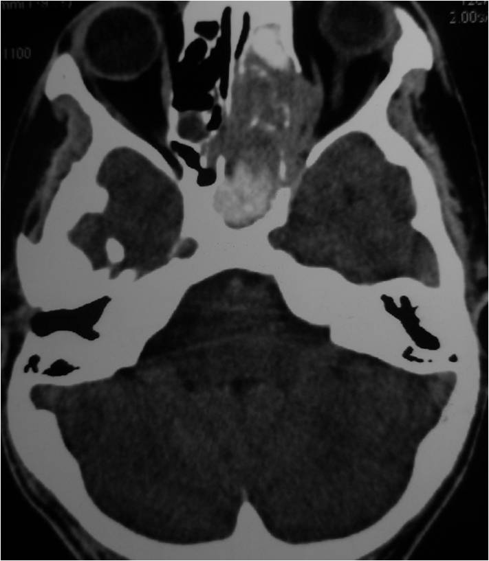 Unilateral maxillary sinusitis CT PNS