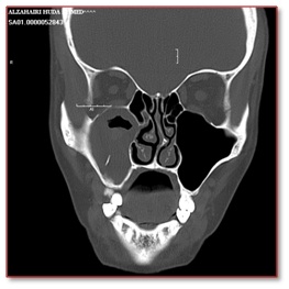 Unilateral maxillary sinusitis CT PNS